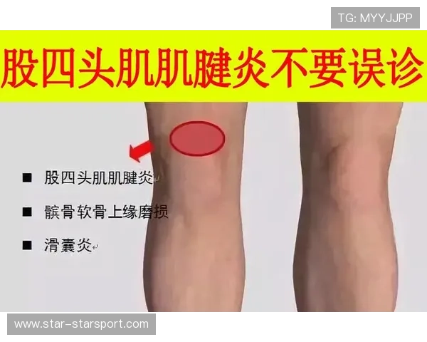 普尔股四头肌拉伤将缺席，股四头肌肌腱拉伤